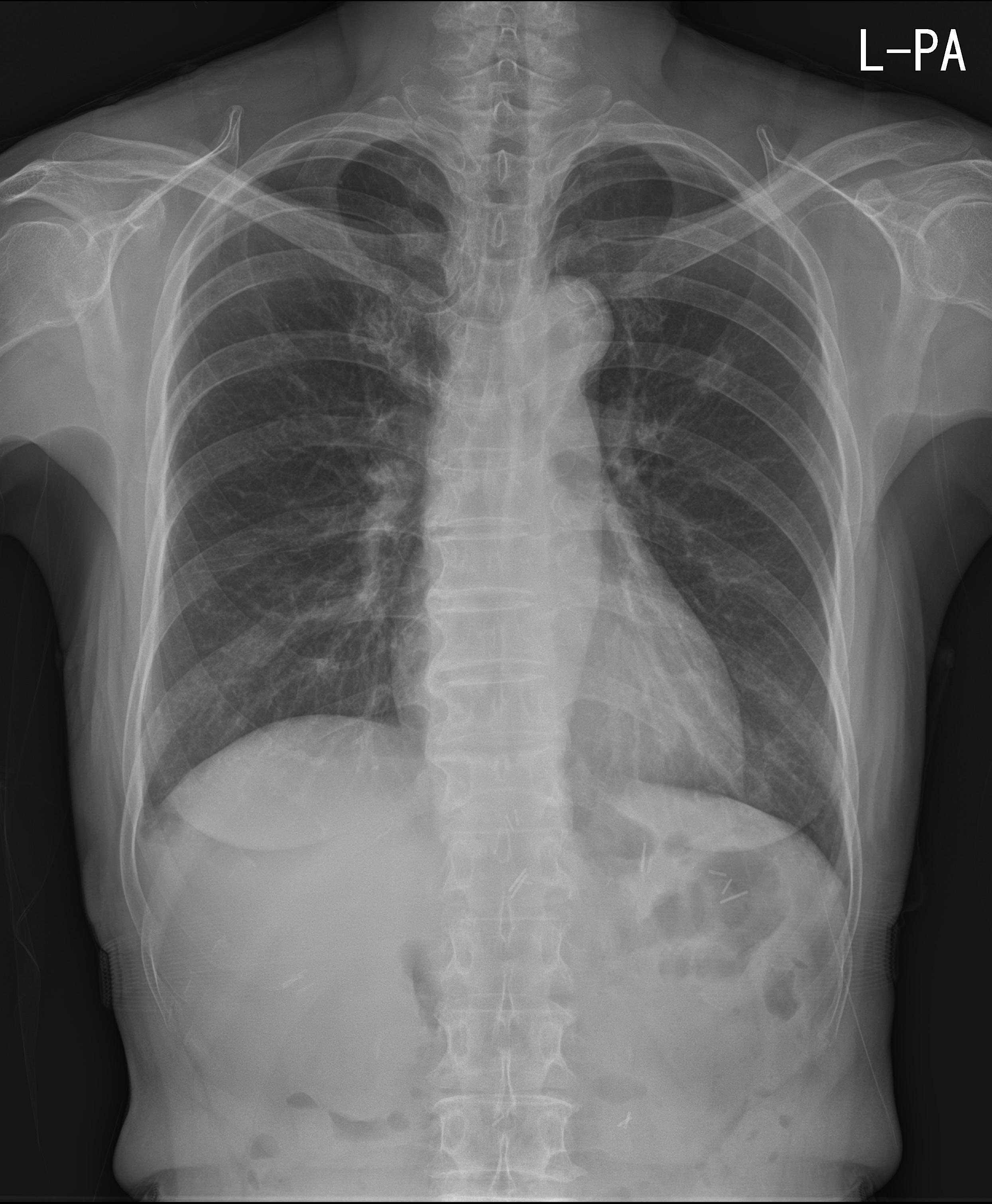 chest x-ray
